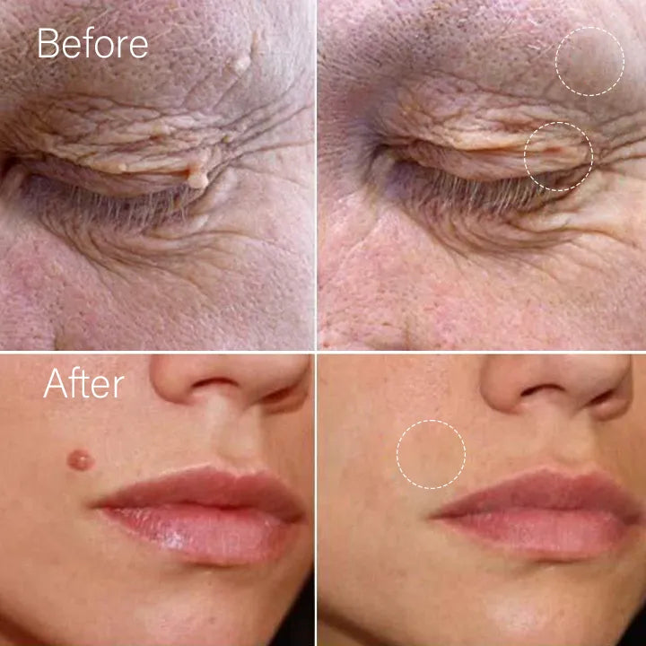 Tag Recede™ - Removedor de Verrugas