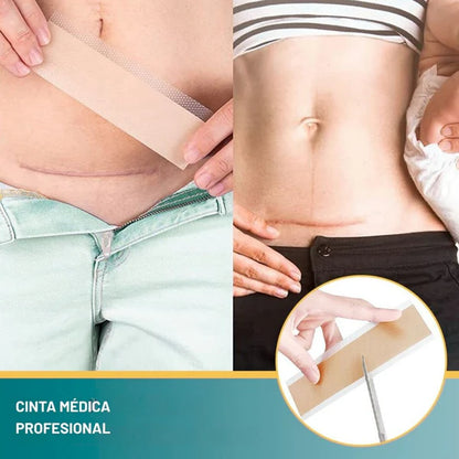 DermaSil™ Cinta Silicona Cicatrizante